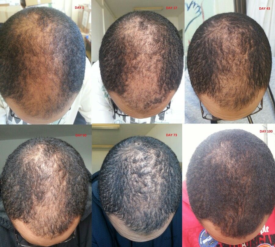 Kirkland 5% Minoxidil Extra Strength Solution For Men