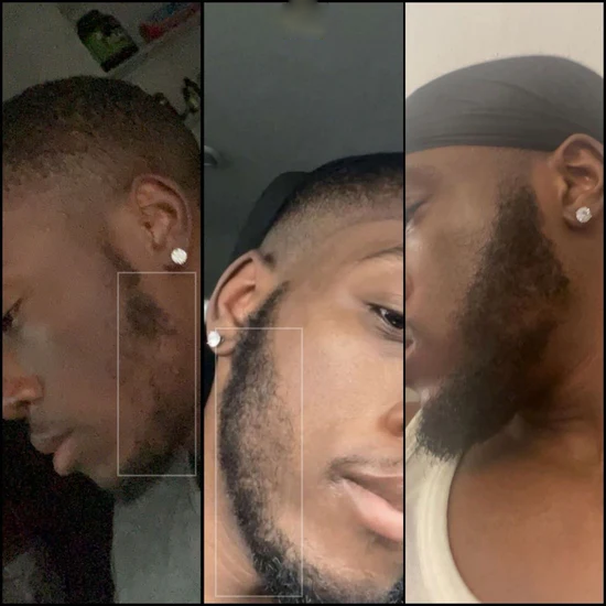 1 Month Kirkland 5% Solution & Derma Roller