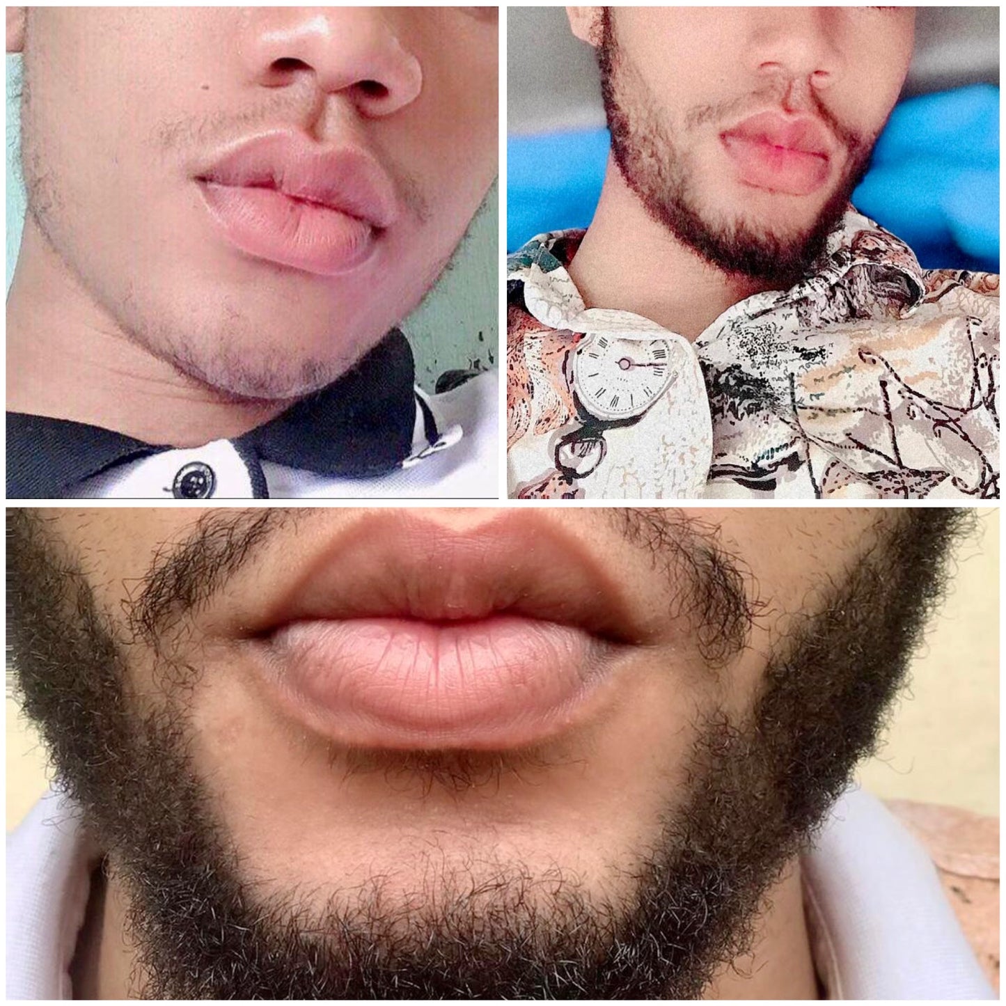 1 Month Kirkland 5% Solution & Derma Roller