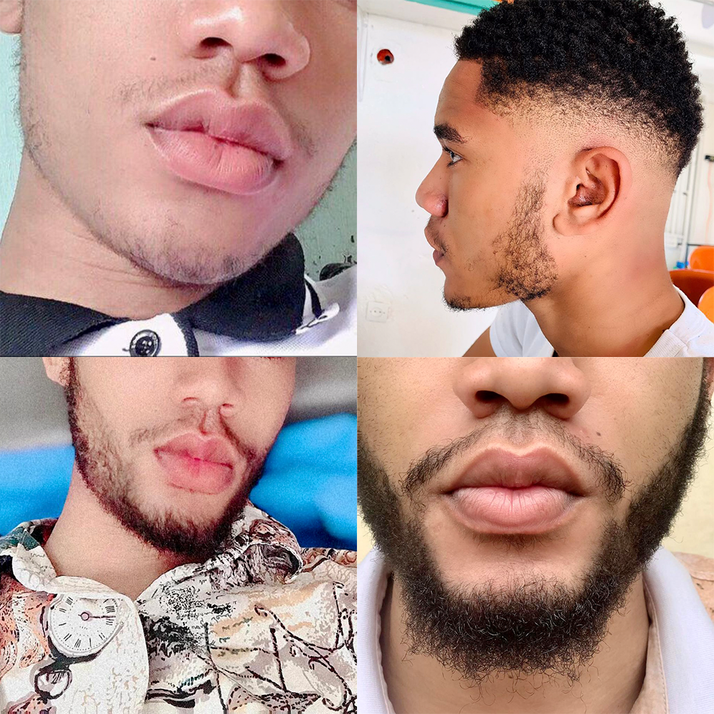 1 Month Kirkland 5% Solution & Derma Roller